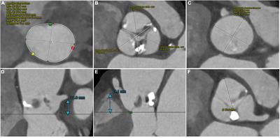 Emergently Alteration of Procedural Strategy During Transcatheter Aortic Valve Replacement to Prevent Coronary Occlusion: A Case Report